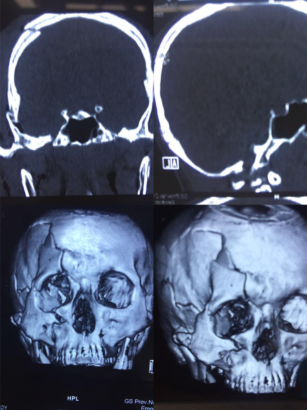 右侧远外侧开颅后颅窝室管膜瘤切除术