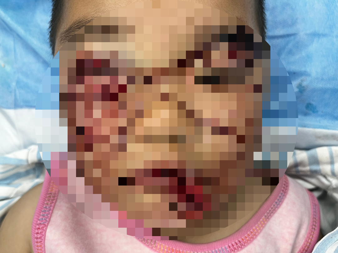 动物门诊用什么x光机揪心！2岁患儿被犬撕咬，省二院动物咬伤门诊这样手术为其保全“颜”面_https://www.jmylbn.com_新闻资讯_第2张