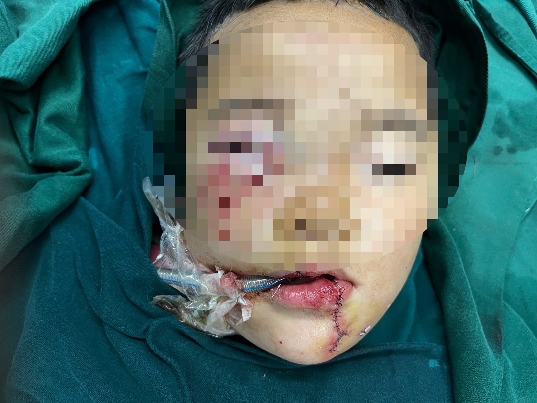 动物门诊用什么x光机揪心！2岁患儿被犬撕咬，省二院动物咬伤门诊这样手术为其保全“颜”面_https://www.jmylbn.com_新闻资讯_第4张